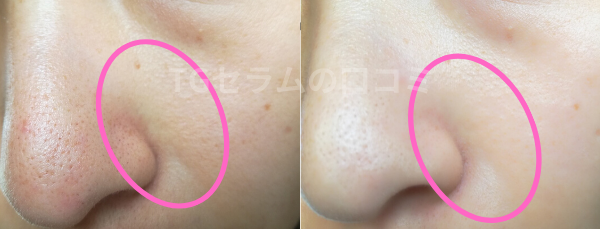 TGセラム　ほうれい線